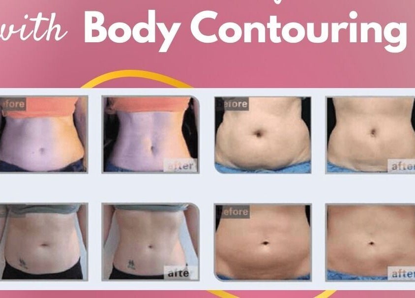 Before and after body contouring results at Pure Bliss Spa, Brantford, Canada, CA.