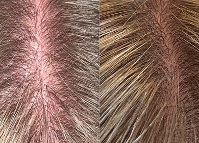 Close-up of scalp transformation at Louise Pynen Advanced Beauty & Aesthetics Ltd, Emsworth, England, GB.