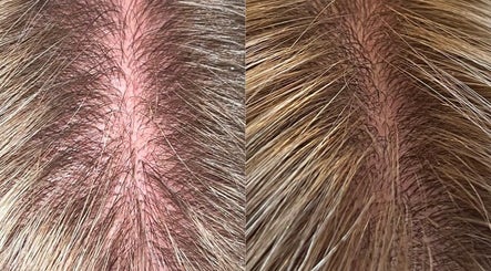 Close-up of scalp transformation at Louise Pynen Advanced Beauty & Aesthetics Ltd, Emsworth, England, GB.