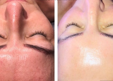 Before and after facial treatment at Louise Pynen Advanced Beauty & Aesthetics Ltd, Emsworth, England, GB.