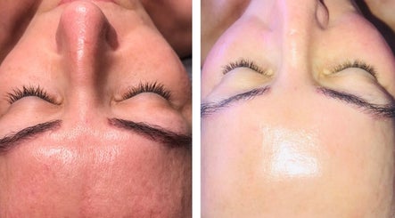 Before and after facial treatment at Louise Pynen Advanced Beauty & Aesthetics Ltd, Emsworth, England, GB.
