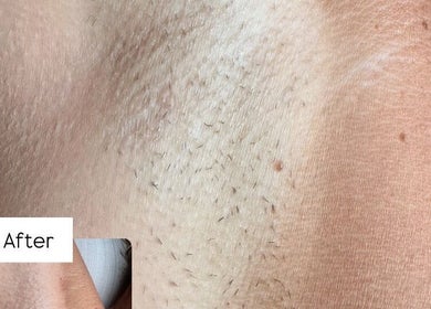 Before and after image of a smooth underarm at Vela Lash Bar, Jacksonville, Florida, US.