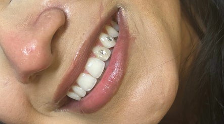 Teeth Whitening -FinestSmilesToronto image 3