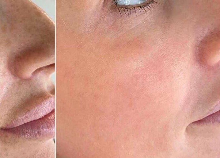 Before and after skincare results at Rebalance Clinic and ITS Academy, New York, New York, US.