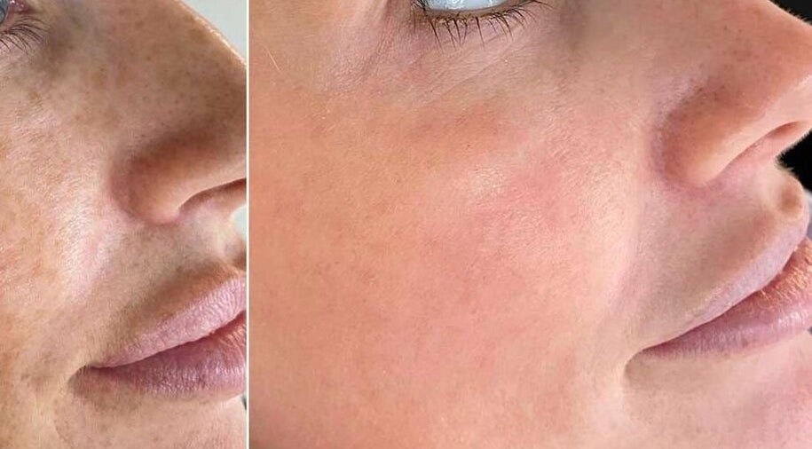 Before and after skincare results at Rebalance Clinic and ITS Academy, New York, New York, US.