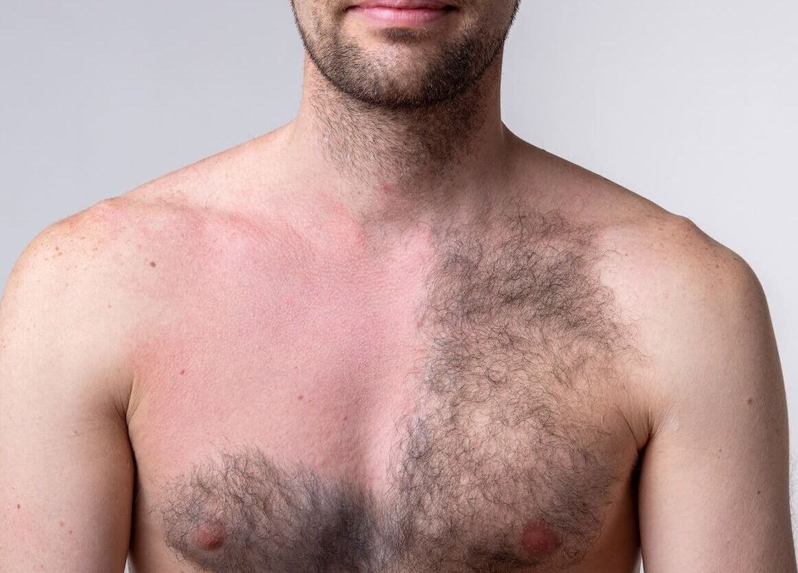 Hair removal treatment showcased at Rebalance Clinic and ITS Academy, New York, New York, US.