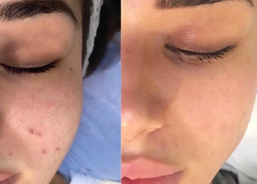 Before and after skin treatment at Rebalance Clinic and ITS Academy in New York, New York, US.