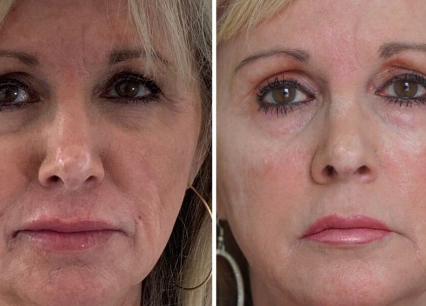 Before and after treatment image at Rebalance Clinic and ITS Academy, New York, New York, US.