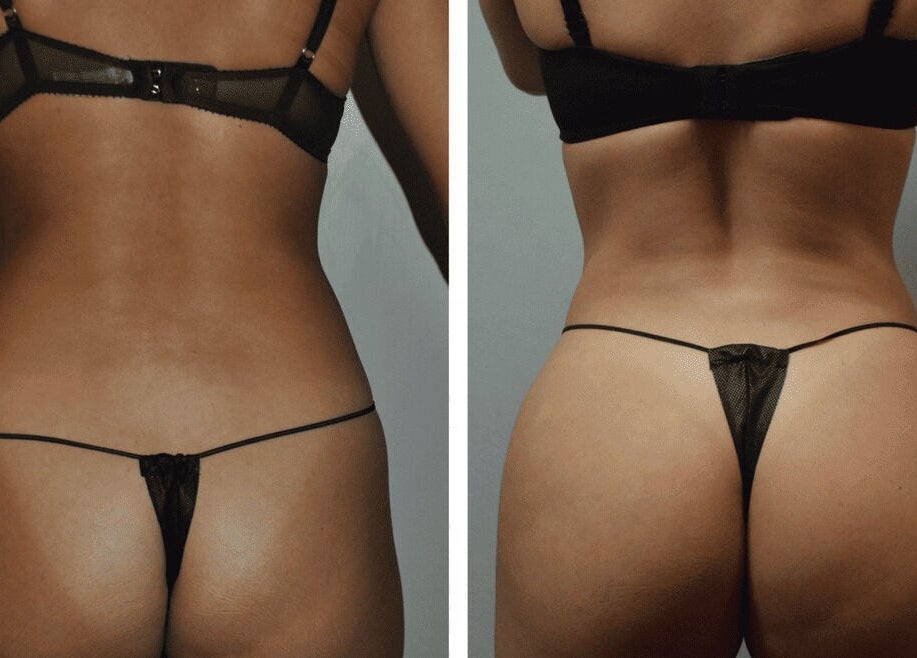 Before-after transformation at Rebalance Clinic and ITS Academy, New York, New York, US showcasing body sculpting.