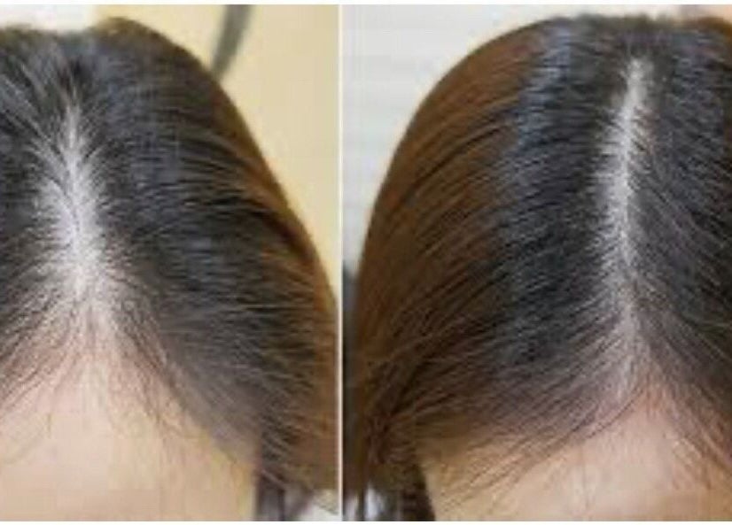 Before and after hair treatment at Rebalance Clinic and ITS Academy, New York, New York, US.
