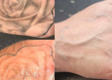 Tattoo removal process at Rotherham Laser and Aesthetic Clinic, Parkgate, England, GB, showcasing before and after results.