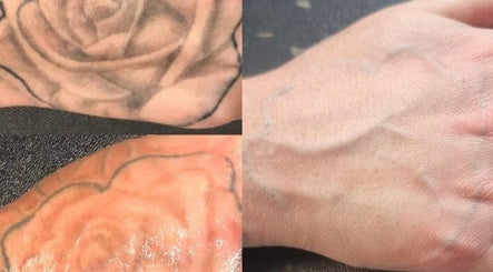 Tattoo removal process at Rotherham Laser and Aesthetic Clinic, Parkgate, England, GB, showcasing before and after results.