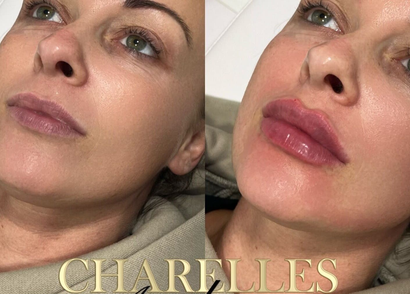 Before and after lip enhancement at Charelles Aesthetics, Uddingston, Scotland, GB.