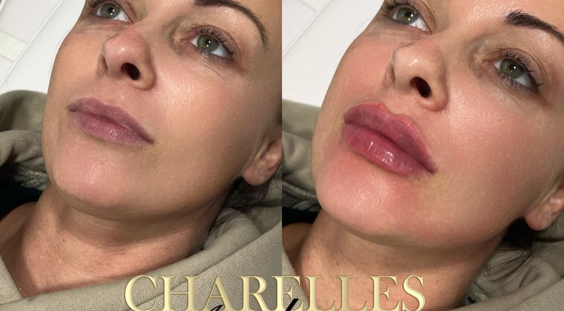 Before and after lip enhancement at Charelles Aesthetics, Uddingston, Scotland, GB.