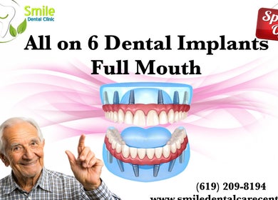 All on 6 dental implants offer at Tijuana Dentist Smile Dental Clinic, Tijuana, Baja California, MX.