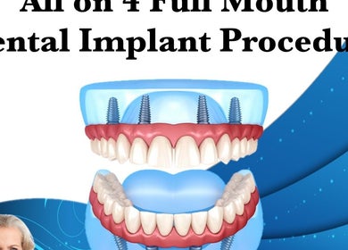 Illustration of All on 4 dental implants at Tijuana Dentist Smile Dental Clinic, Tijuana, Baja California, MX.