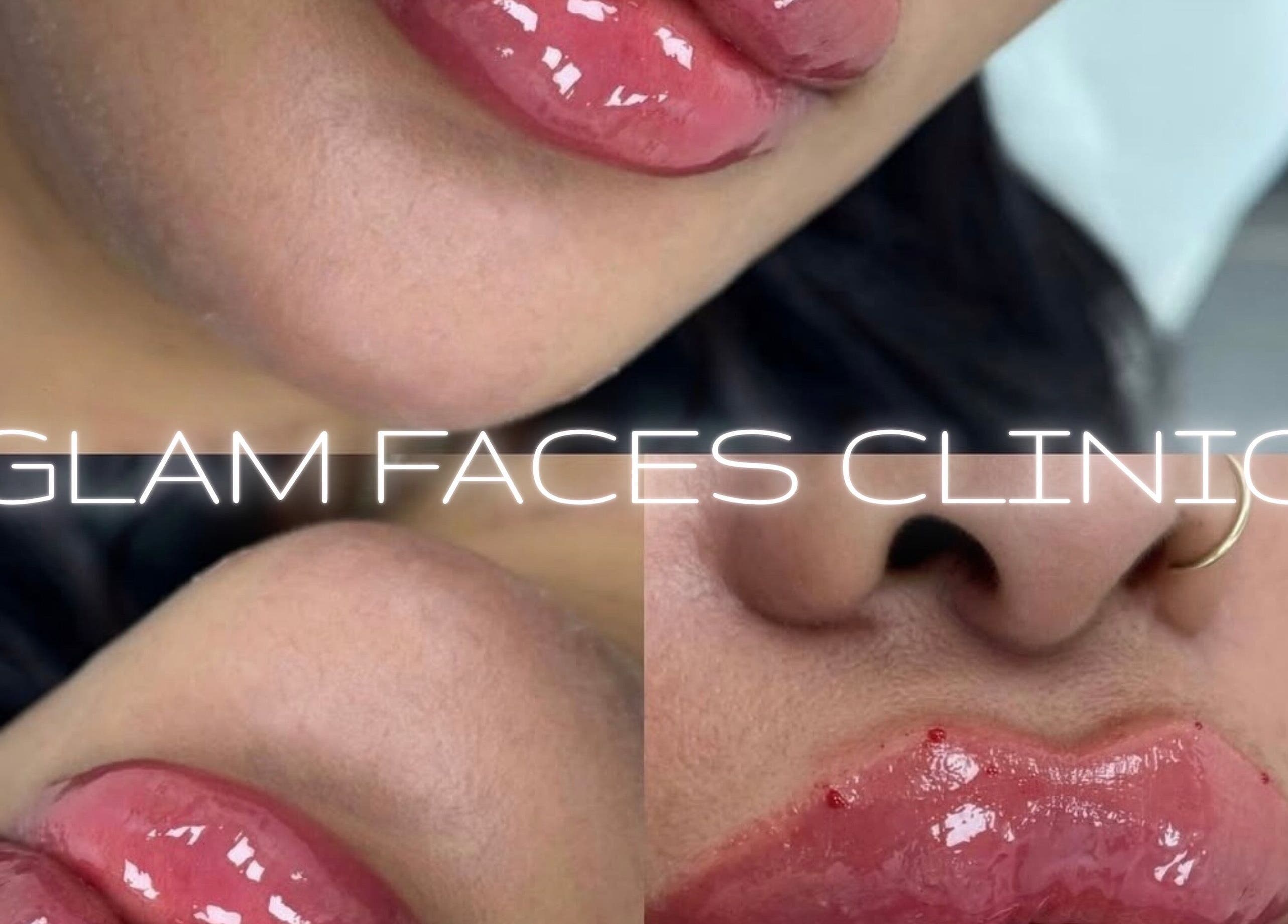 Luscious lip enhancement at GLAM FACES CLINIC, Radlett, England, GB. Experience premium beauty treatments.