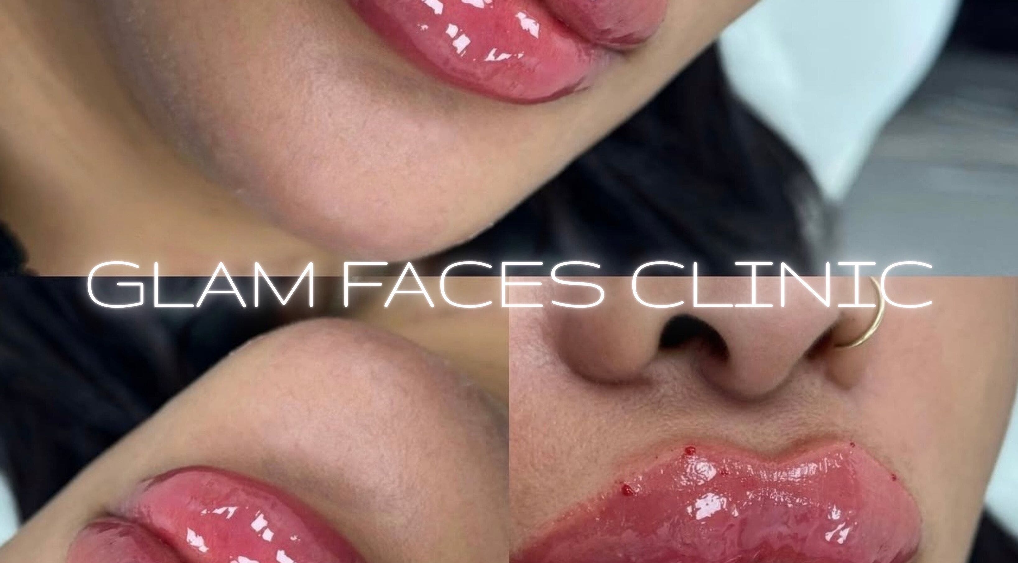 Luscious lip enhancement at GLAM FACES CLINIC, Radlett, England, GB. Experience premium beauty treatments.