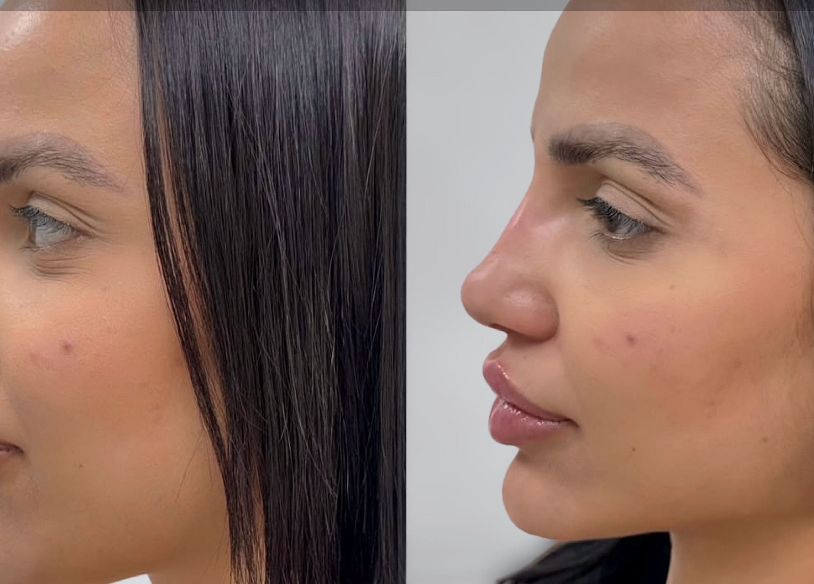 Side profile before and after skincare treatment at GLAM FACES CLINIC, Radlett, England, GB.