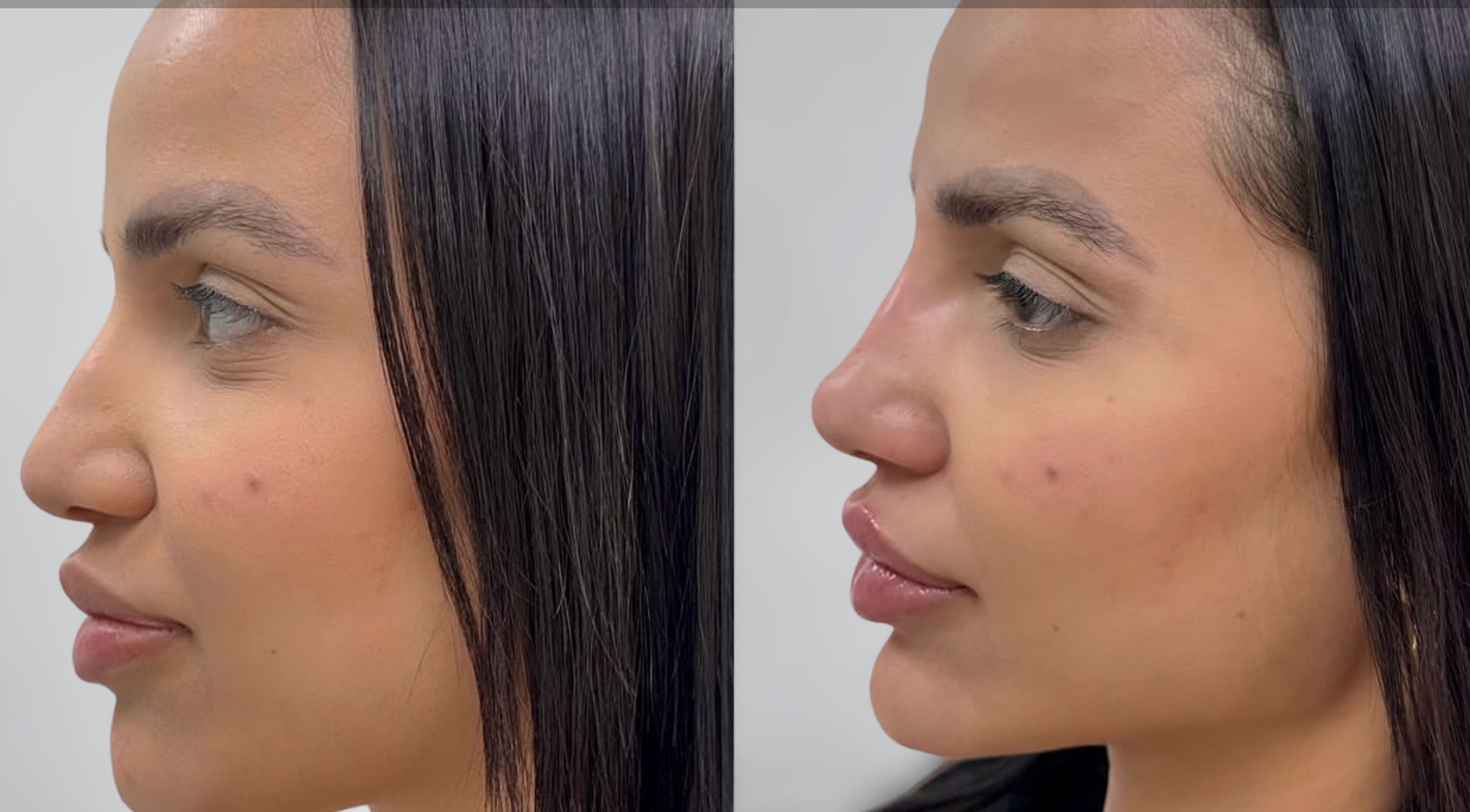 Side profile before and after skincare treatment at GLAM FACES CLINIC, Radlett, England, GB.