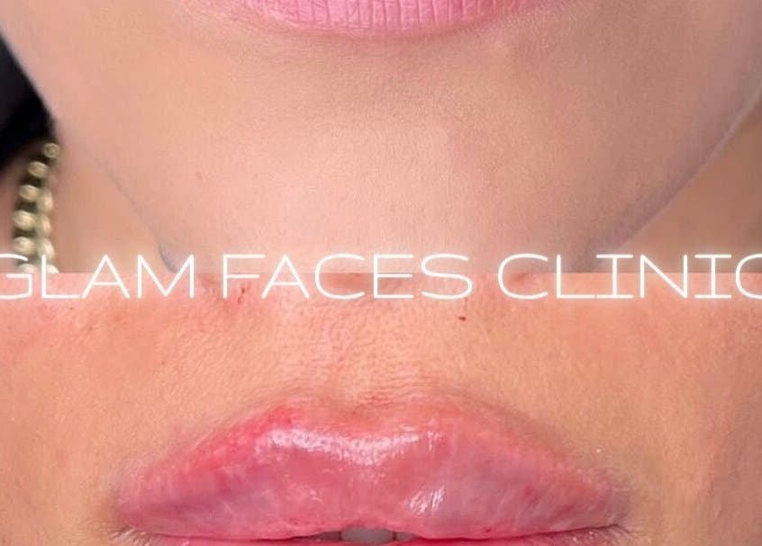 Before and after lip enhancement at GLAM FACES CLINIC, Radlett, England, GB. Expert cosmetic results.