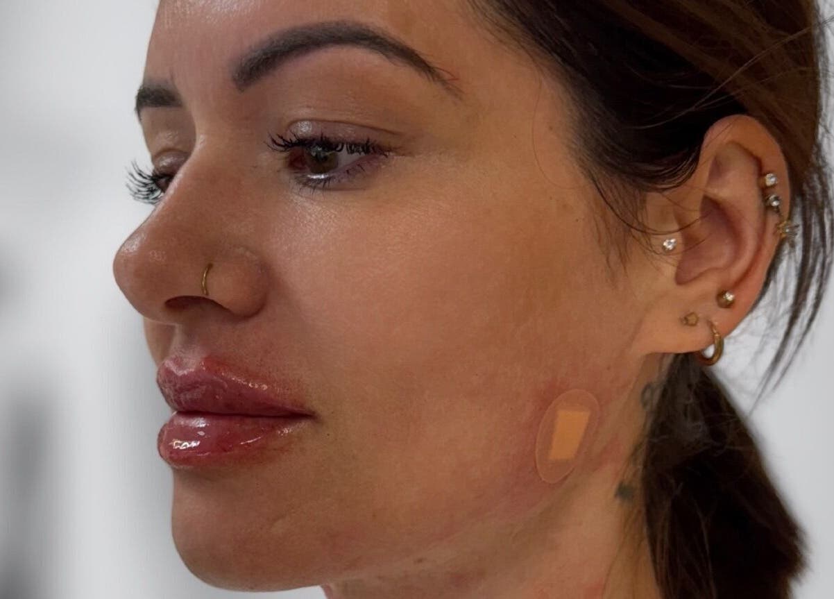 Client with glowing skin at GLAM FACES CLINIC, Radlett, England, GB showcasing post-treatment results.