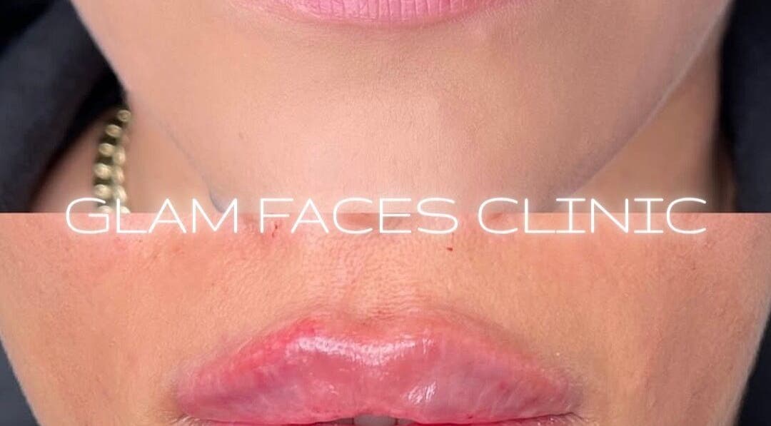 Close-up of lip enhancement at GLAM FACES CLINIC, London, England, GB showcasing before and after results.