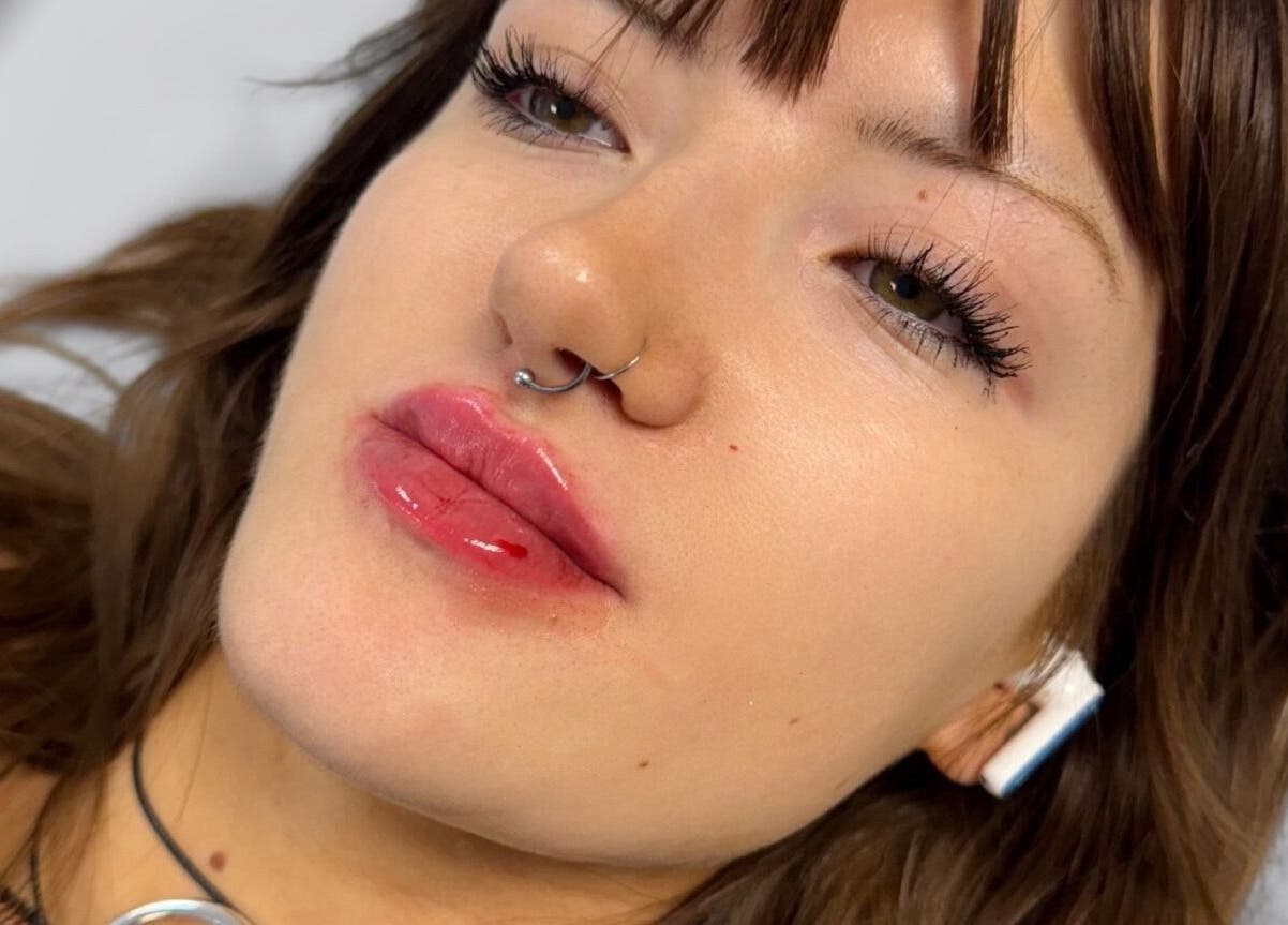 Client with enhanced lips at GLAM FACES CLINIC, London, England highlighting expert artistry and beauty care.