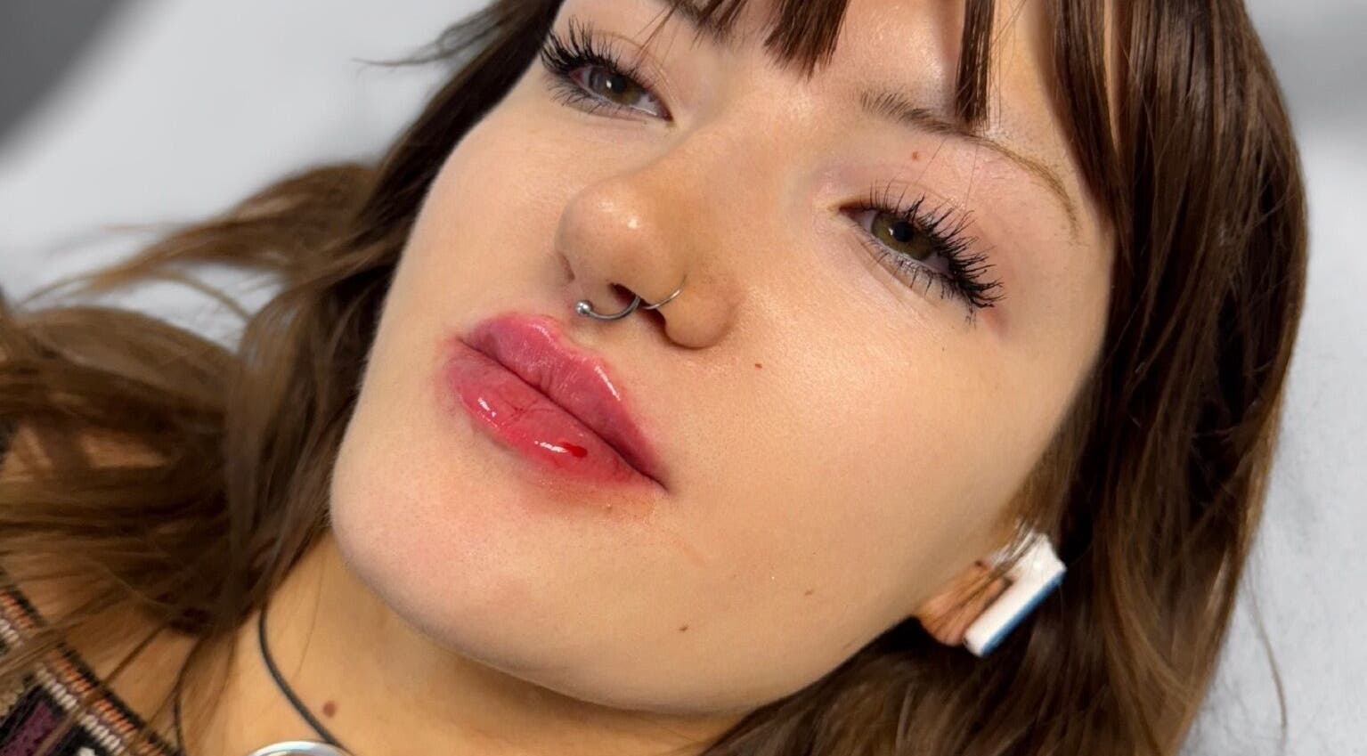 Client with enhanced lips at GLAM FACES CLINIC, London, England highlighting expert artistry and beauty care.