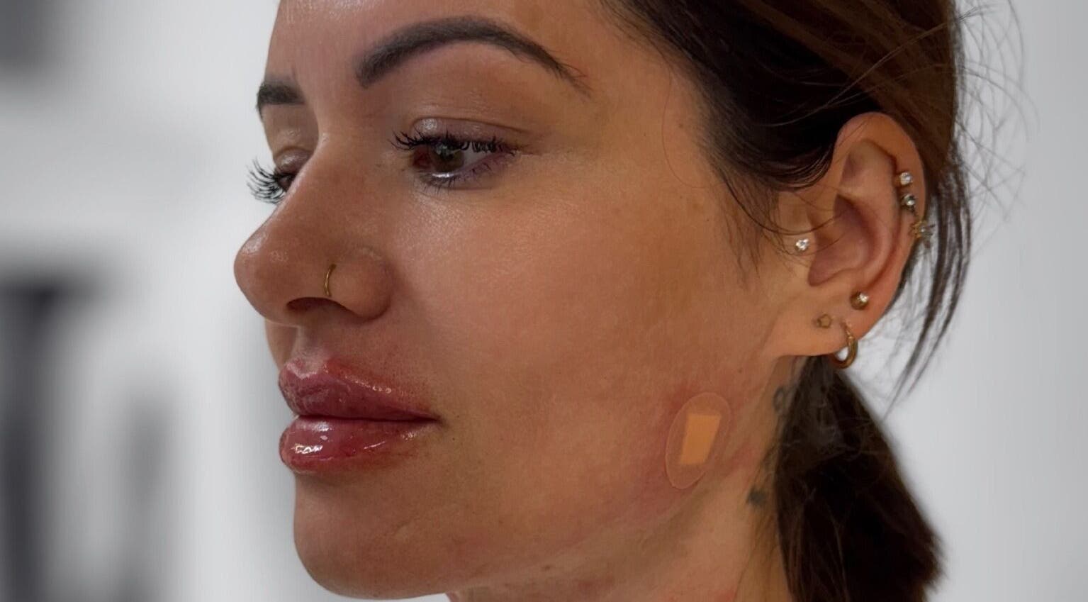 Client's glowing complexion at GLAM FACES CLINIC, London, England, GB, showcasing beauty enhancement.