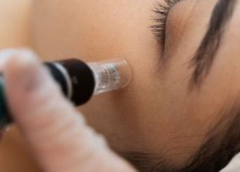 Facial treatment at Quinns Tanning and Aesthetics, London, England, GB, showcasing skin rejuvenation process.