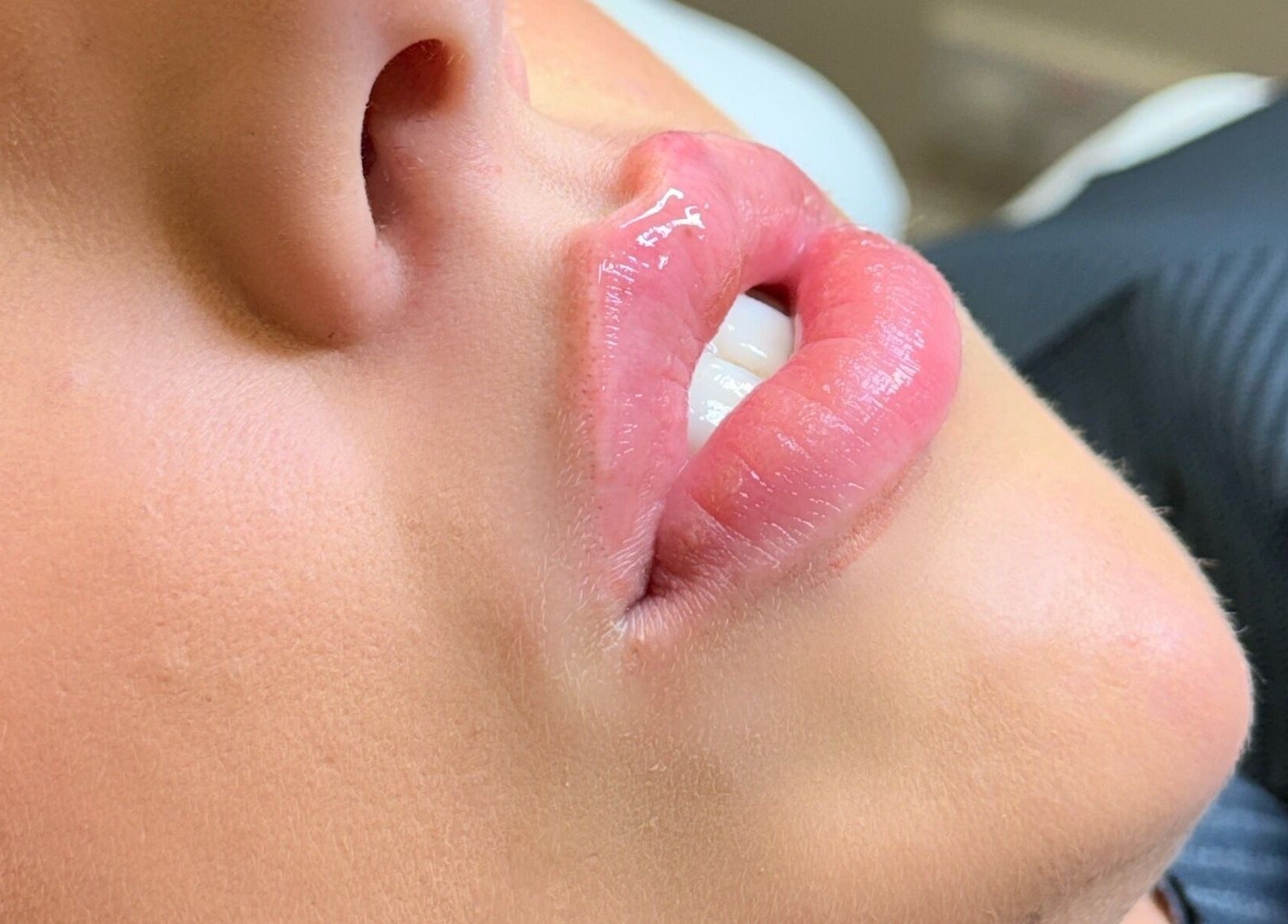 Plump lips treatment at Quinns Tanning and Aesthetics, London, England, GB. Experience rejuvenated beauty.