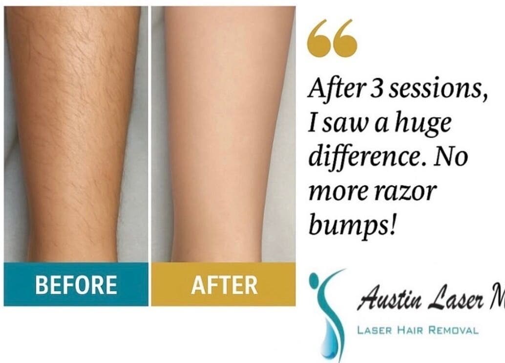Before and after hair removal at Austin Laser Med Spa in Cedar Park, Texas, US. Notable skin improvement.