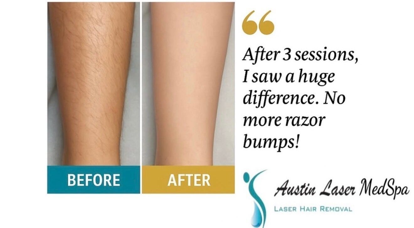 Before and after hair removal at Austin Laser Med Spa in Cedar Park, Texas, US. Notable skin improvement.