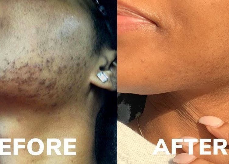 Before and after skin treatment at Austin Laser Med Spa in Cedar Park, Texas, US showing clear improvement.