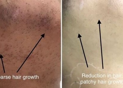 Before and after laser treatment at Austin Laser Med Spa, Cedar Park, Texas showing reduced hair growth.
