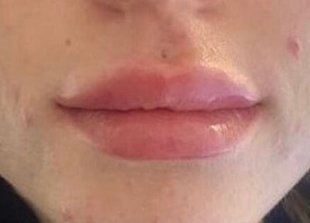 Close-up of enhanced lips treated at Hers & Sirs, Manchester, England, GB.