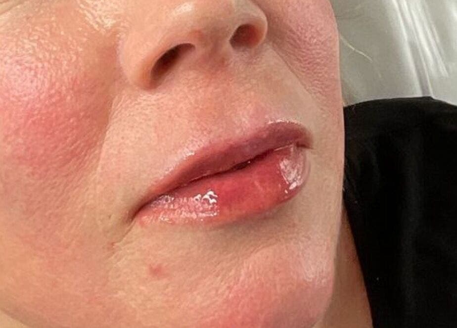 Close-up of glossy lip treatment at Radiant by Julie in Derby, England, GB, showcasing smooth and hydrated lips.