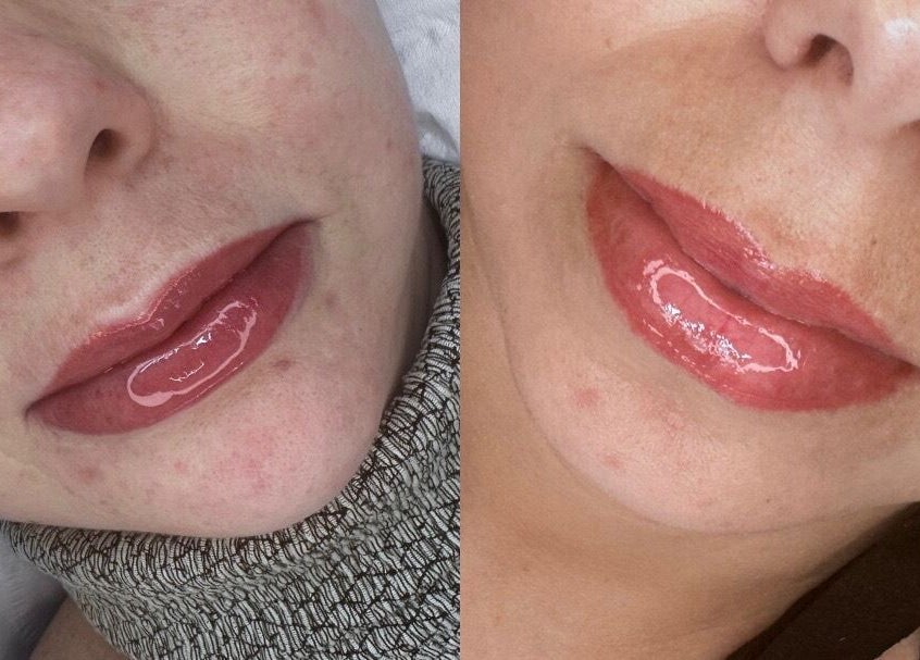 Lip enhancement at Rebecca Beards Clinic in Bridgend, Wales, CF31 2ES, GB, showcasing glossy finish.