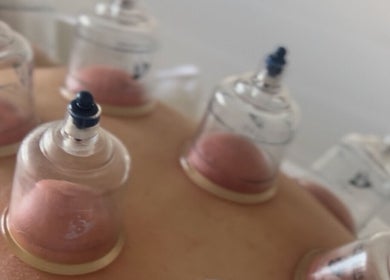 Cupping therapy session at Phoenix Remedial Massage in Belford, New South Wales, AU.