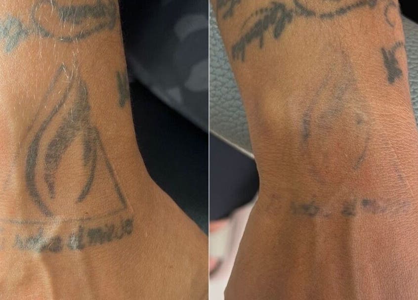 Tattoo fading service at Relax Med Aesthetics in Port of Spain, Port of Spain Corporation, TT showing before and after.