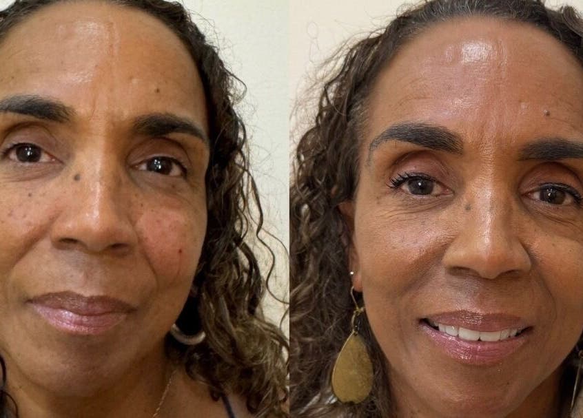 Before and after skincare results at Relax Med Aesthetics, Port of Spain, Port of Spain Corporation, TT.