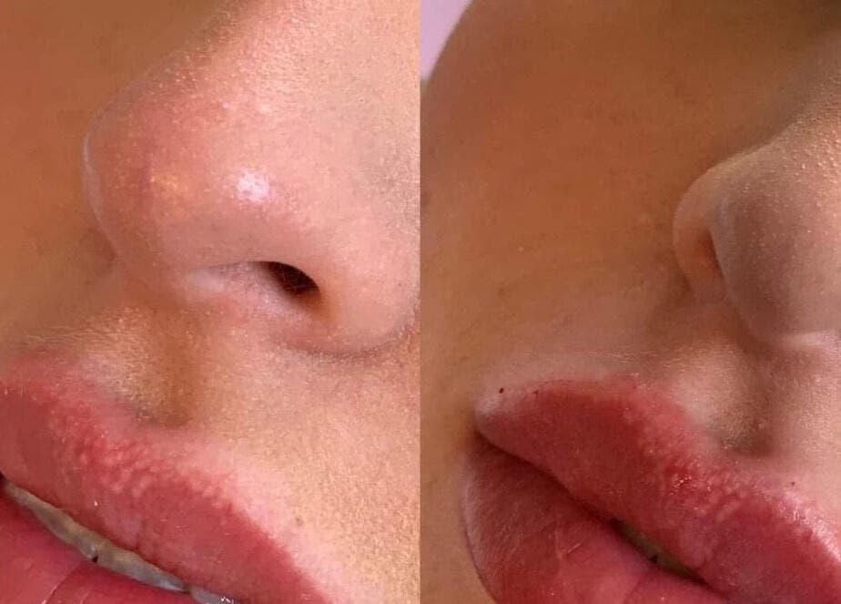 Dermal filler results at K&E Pro Aesthetics Ltd, Bar Hill, England, showcasing smooth skin enhancement.