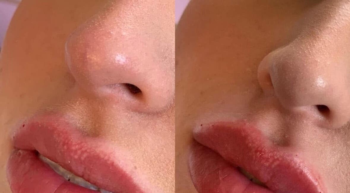 Dermal filler results at K&E Pro Aesthetics Ltd, Bar Hill, England, showcasing smooth skin enhancement.