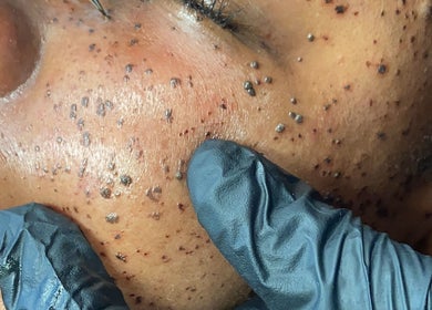 Close-up of facial treatment at Mpumalanga - eMalahleni (@GreenLeaf Day Spa), Emalahleni, Mpumalanga, ZA.