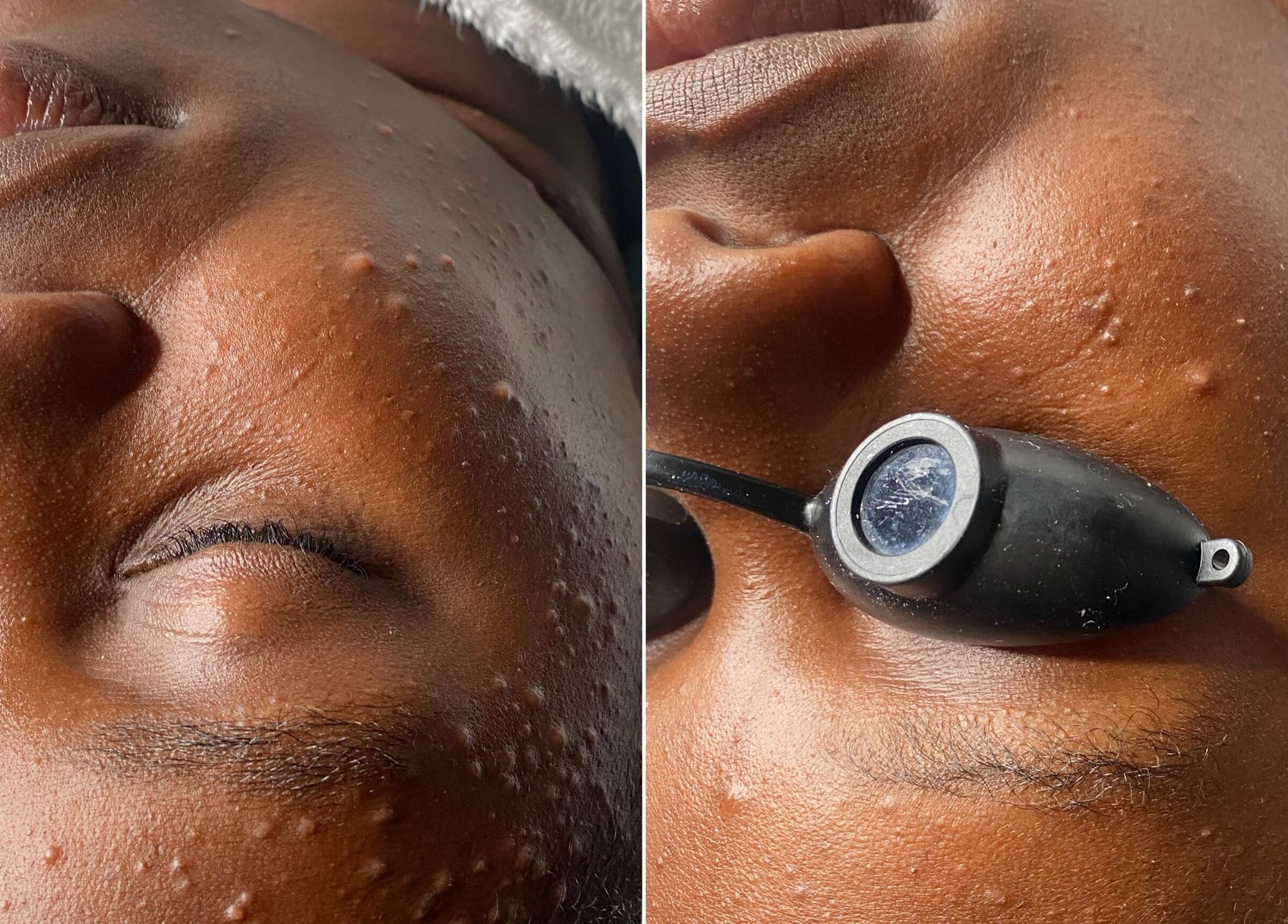Close-up of facial treatment at Ruellia Aesthetics, Kingston, St. Andrew Parish, JM, highlighting skin care process.