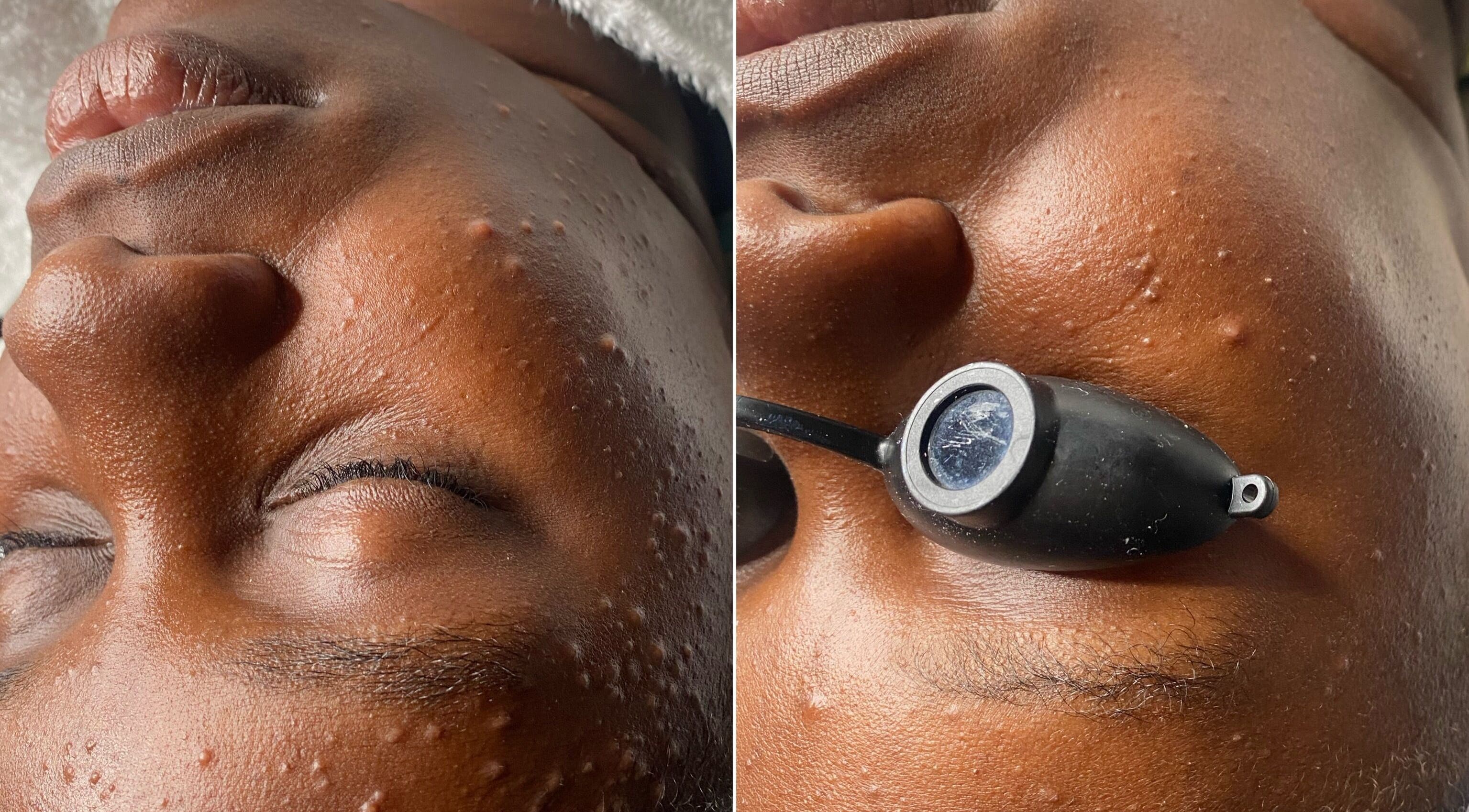 Close-up of facial treatment at Ruellia Aesthetics, Kingston, St. Andrew Parish, JM, highlighting skin care process.