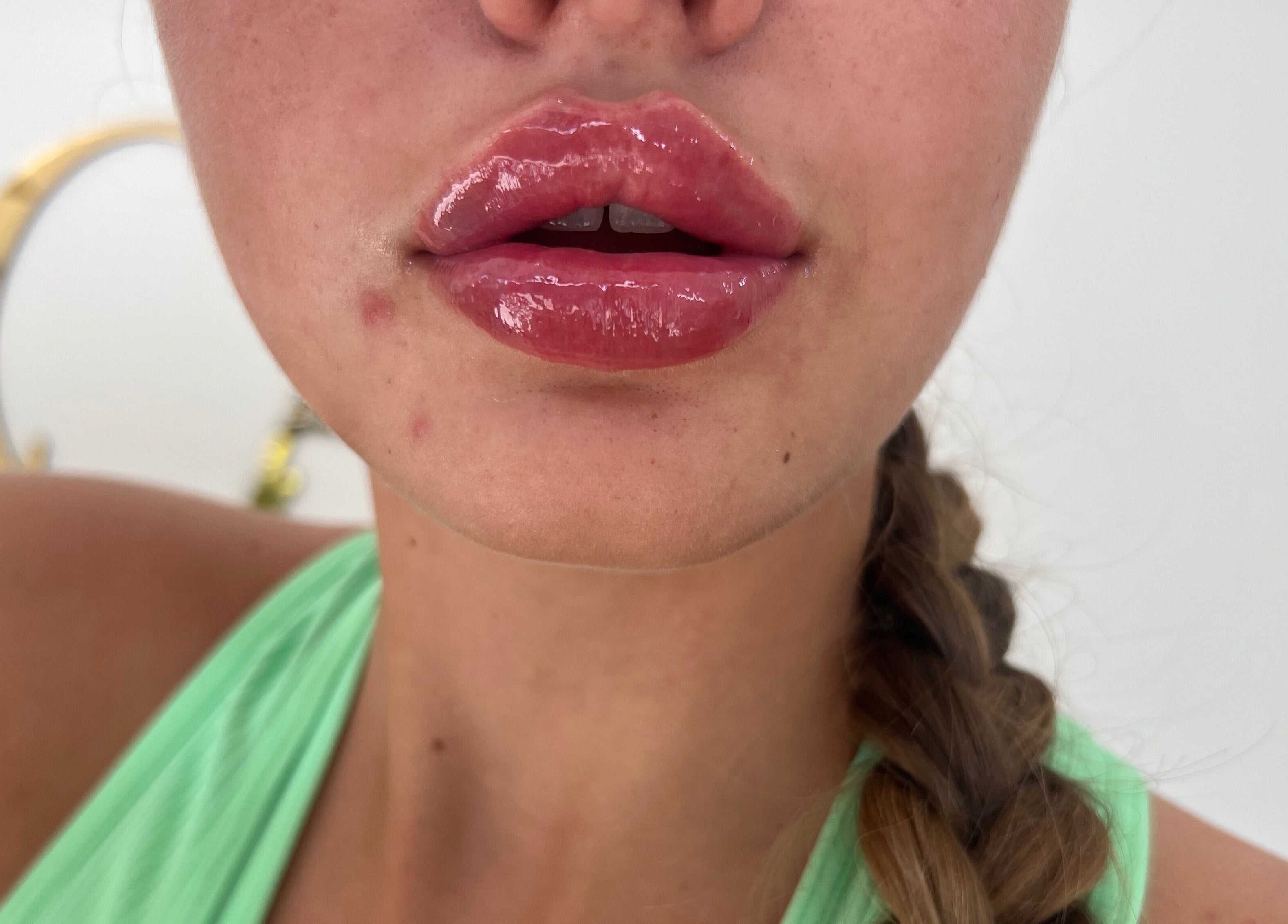 Close-up of glossy lips treatment at Lauren Cosmetic Aesthetics, Wigan, England, GB.