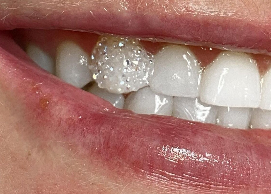 Close-up of a bright smile with a shimmering accent at AB Aesthetics, South Morang, Victoria, AU.