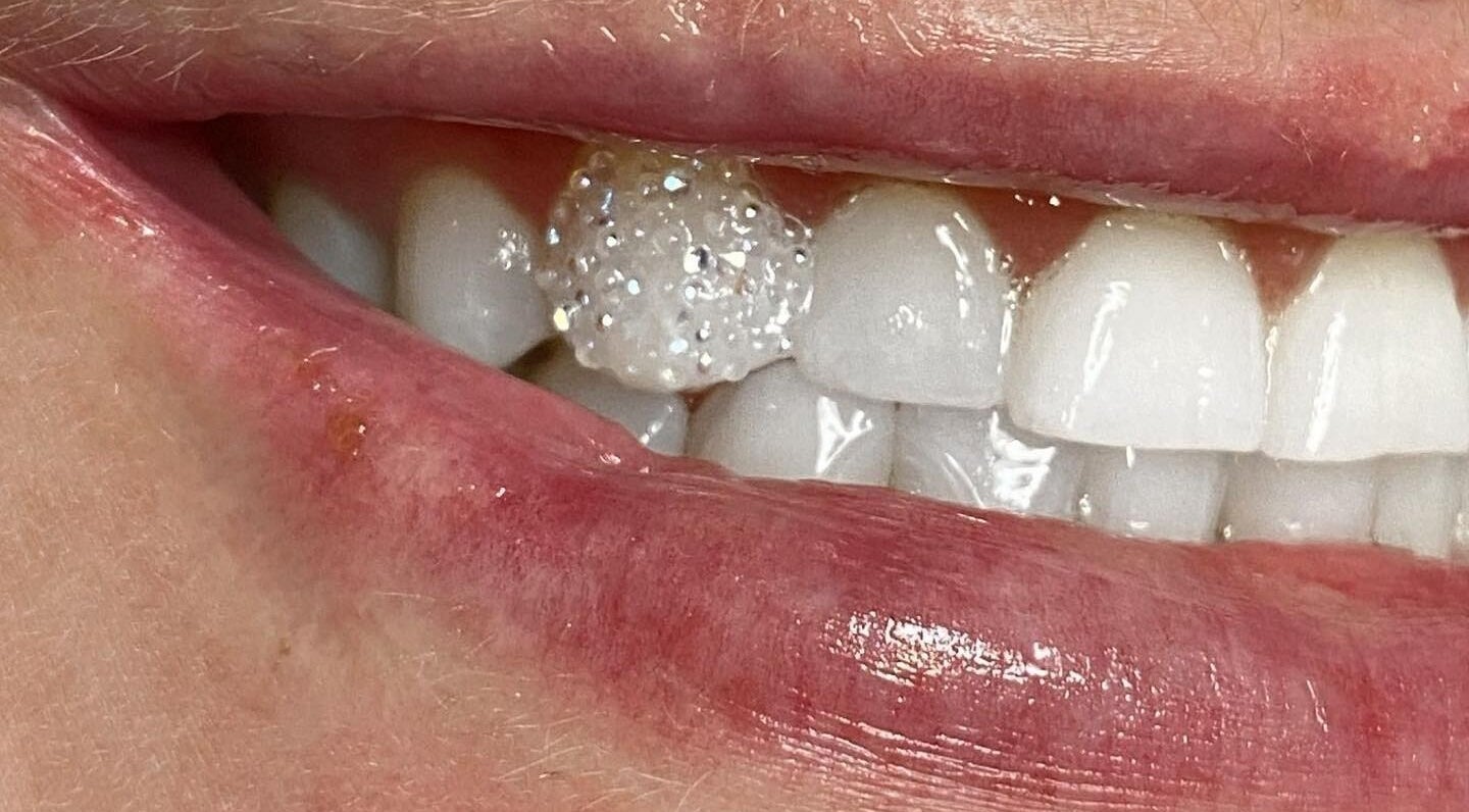 Close-up of a bright smile with a shimmering accent at AB Aesthetics, South Morang, Victoria, AU.